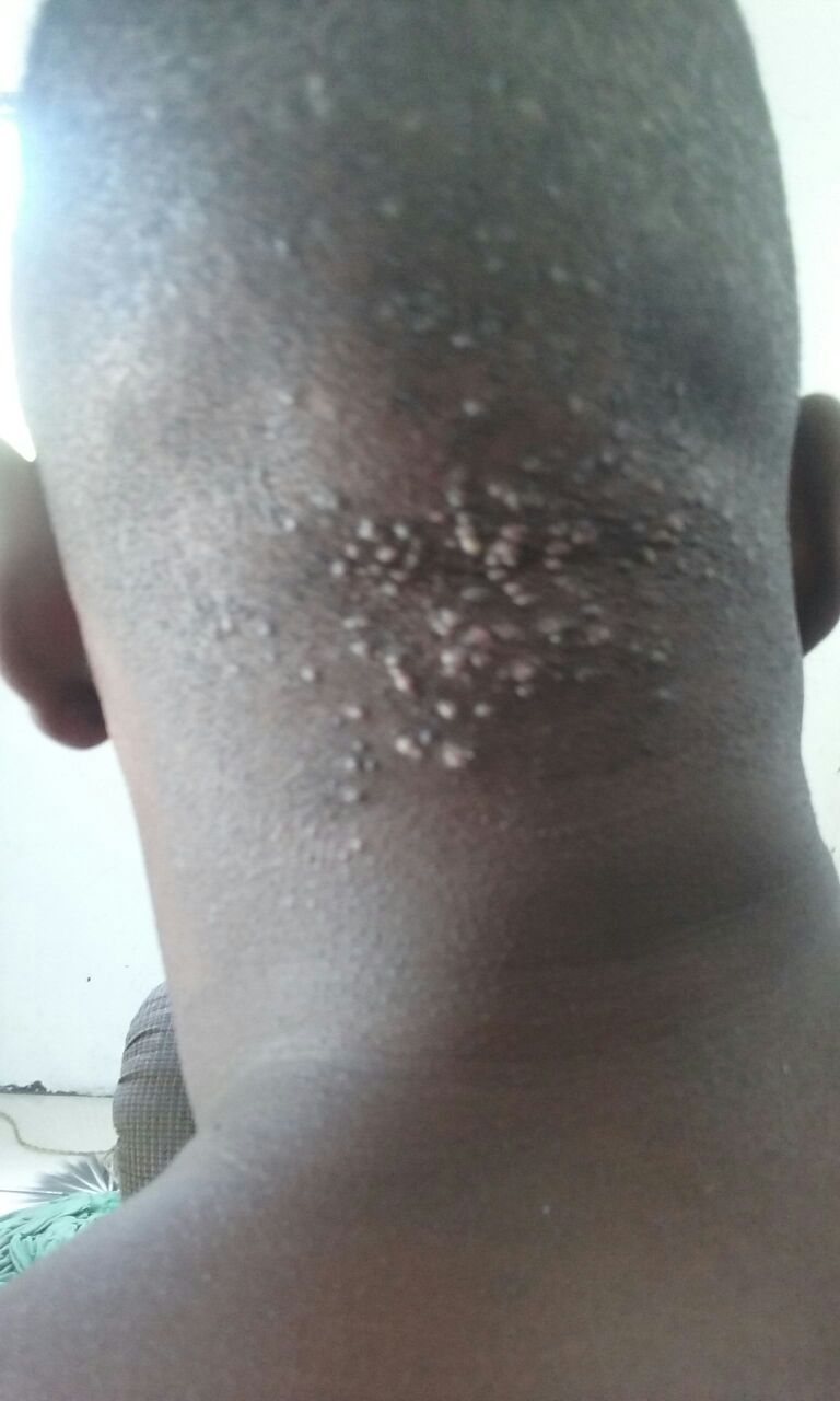 Foliculite antes do Tend Skin — pele com pústulas e inflamação visível